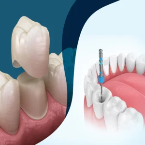 مراحل عصب کشی و روکش دندان