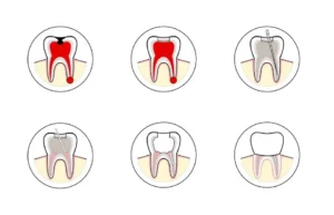 مراحل عصب کشی و روکش دندان
