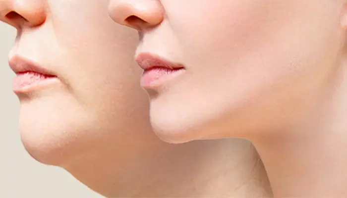 رفع غبغب بدون جراحی