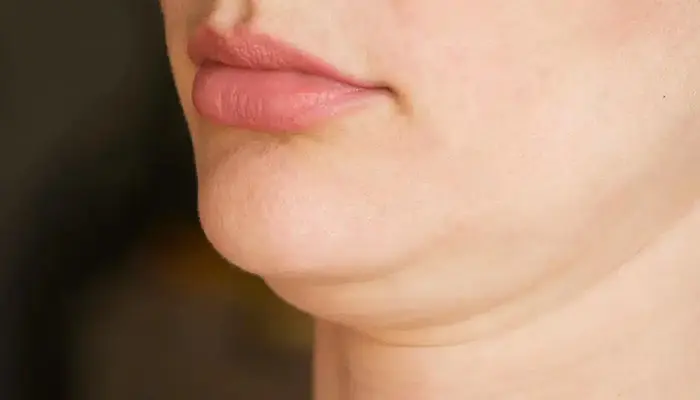 مزوتراپی غبغب